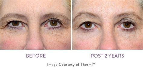 thermismooth atlanta|THERMIsmooth Face Treatment Atlanta .
